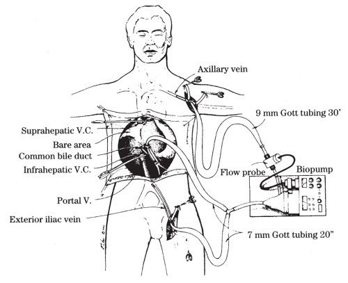 Liver Transplantation | Abdominal Key