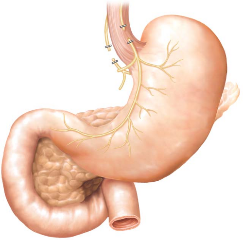 Truncal Vagotomy And Pyloroplasty Abdominal Key