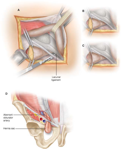 Femoral Hernia (CONTINUED): Surgical Repair of Femoral Hernia