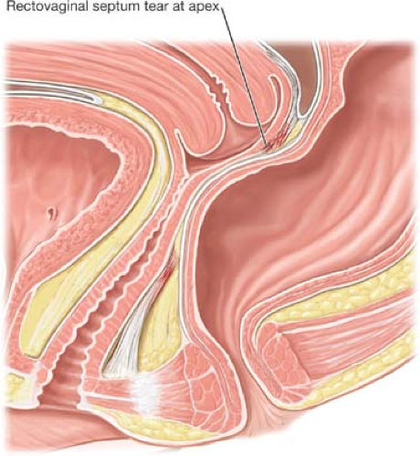 rectovaginal fascia