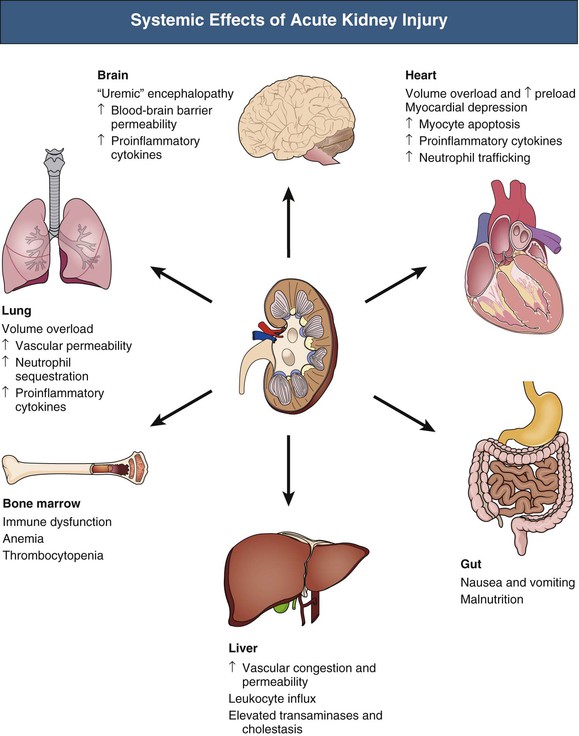 Acute Kidney Injury Diagram