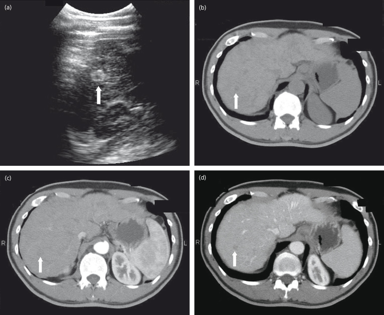 Secondary Malignant Neoplasm Of Liver Icd 10