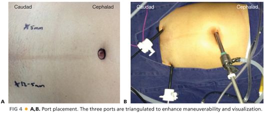 Appendectomy Laparoscopic Technique Abdominal Key