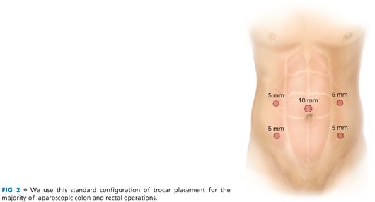 Laparoscopic Transverse Colectomy Abdominal Key 2784