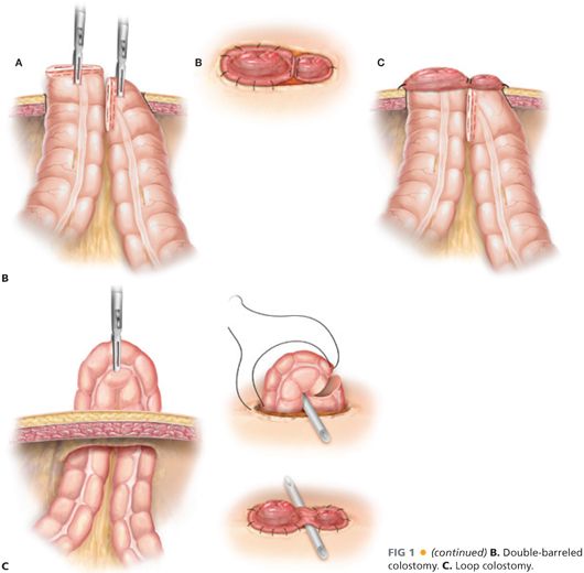 loop colostomy reversal