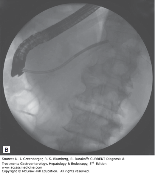 Endoscopic Retrograde Cholangiopancreatography | Abdominal Key