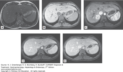 Liver Neoplasms | Abdominal Key