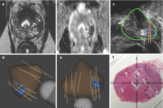 Multiparametric Magnetic Resonance Imaging For Prostate Cancer ...