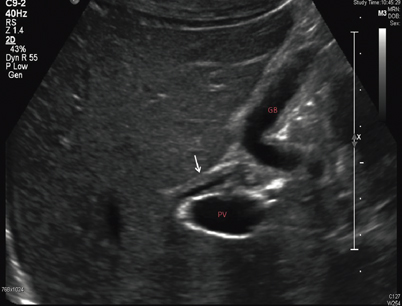 Diagnostic Procedures in Pediatric Hepatology | Abdominal Key