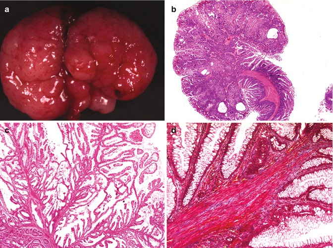 Polyps and Tumors of the Gastrointestinal Tract in Childhood ...