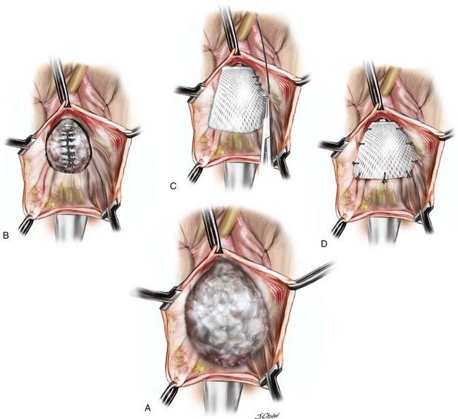 Surgical Management Of Anterior Vaginal Wall Prolapse Abdominal Key 1400