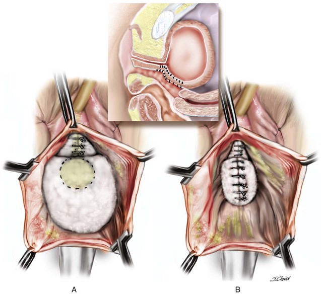Surgical Management of Anterior Vaginal Wall Prolapse
