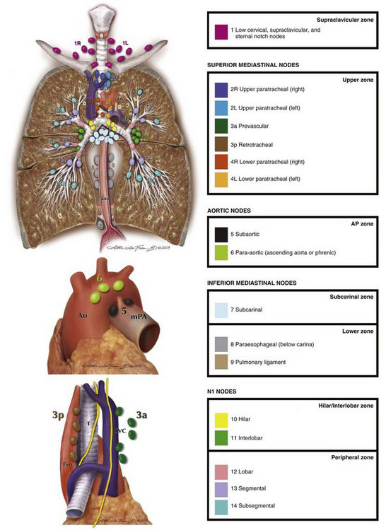 Thoracoscopic Lung Resections | Abdominal Key