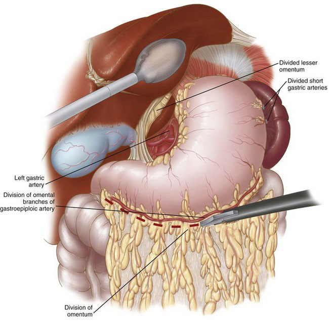 Minimally Invasive Ivor Lewis Esophagectomy Abdominal Key