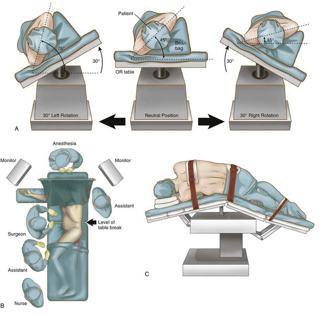 Minimally Invasive Splenectomy For Massive Splenomegaly