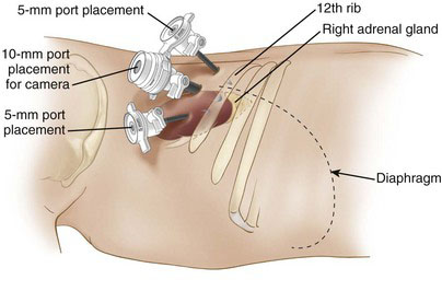 First port placement - Port placement in minimally invasive