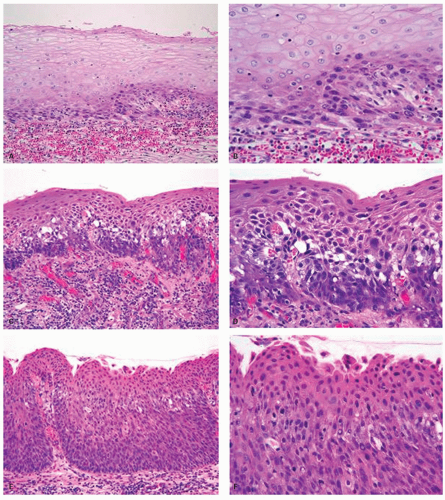 Polyps and Tumors of the Esophagus | Abdominal Key