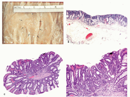 fragments of tubular adenoma and hyperplastic polyp