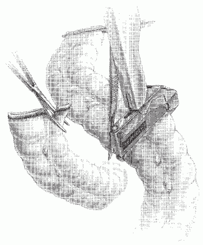 C23-FF66.gif | Abdominal Key