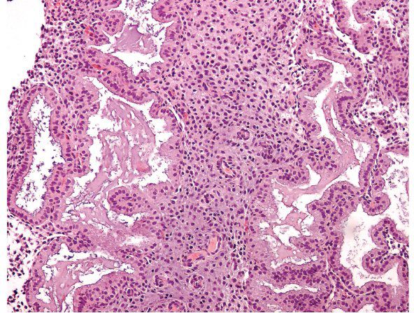 Pathology secretory endometrium Endometrial hyperplasia