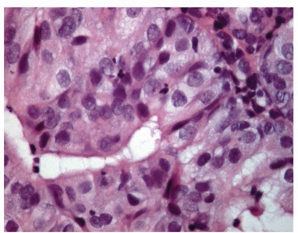 Eosinophilic Metaplasia Endometrium