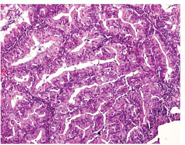 Eosinophilic Metaplasia Endometrium