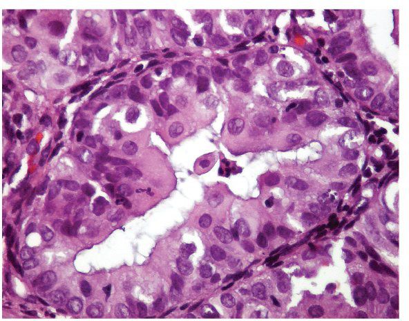 Eosinophilic Metaplasia Endometrium