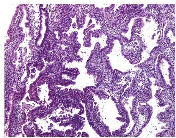 Eosinophilic Metaplasia Endometrium