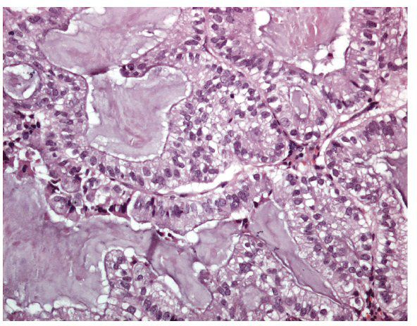 Endometrial Carcinomas | Abdominal Key