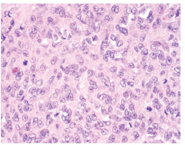 Mixed and Mesenchymal Tumors of the Uterine Cervix and Corpus ...