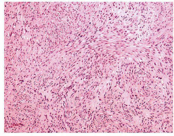 Mixed and Mesenchymal Tumors of the Uterine Cervix and Corpus ...