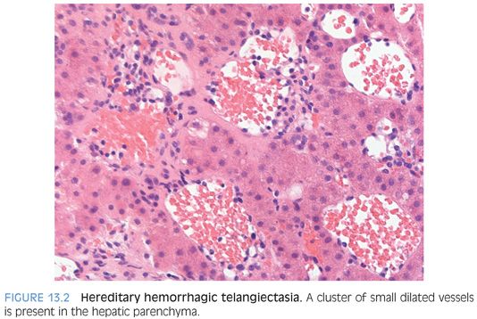 hereditary hemorrhagic telangiectasia histology