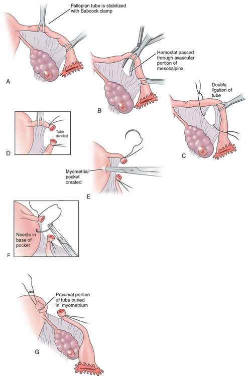 PDF) Spontaneous tubal re-canalisation: A late complication of Falope ring  sterilisation