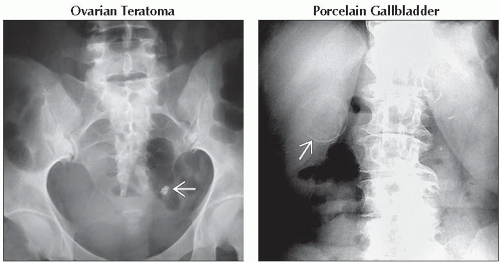 DA1-DB1-Abdominal_Calcifications-FFU10.gif | Abdominal Key