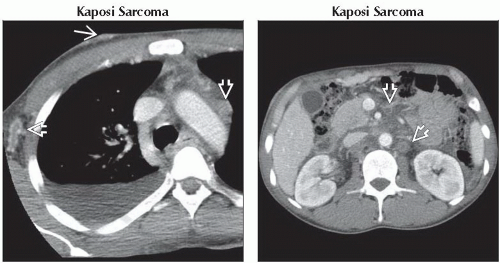 DA1-DB1-Mesenteric_Lymphadenopathy-FFU6.gif | Abdominal Key