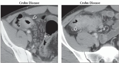 DA1-DB1-Misty_Infiltrated_Mesentery-FFU6.gif | Abdominal Key