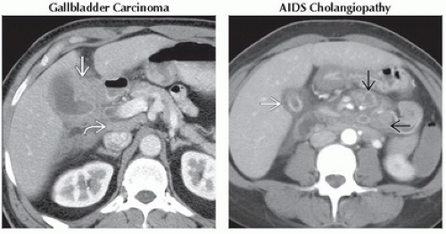 DA10-DB1-Diffuse_Gallbladder_Wall_Thickening-FFU4.gif | Abdominal Key