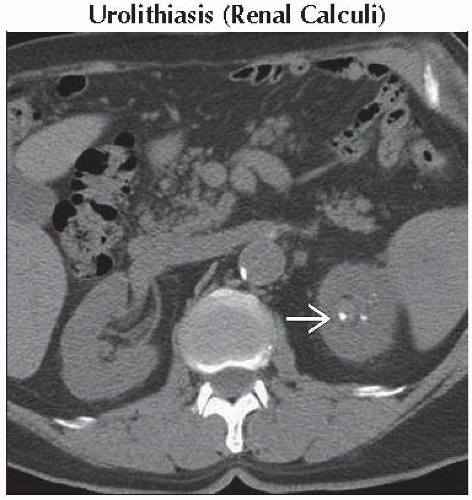 Da15 Db1 Calcifiedsmalllesioninkidney Ffu2 Abdominal Key