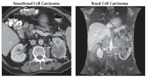 DA15-DB1-Delayed_or_Persistent_Nephrogram-FFU3.gif | Abdominal Key