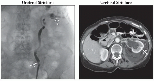 DA15-DB1-Delayed_or_Persistent_Nephrogram-FFU6.gif | Abdominal Key