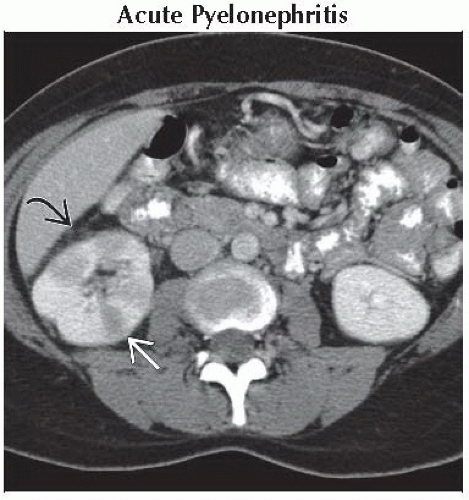 DA15 DB1 Wedge shaped or Striated Nephrogram FFU1 gif Abdominal Key