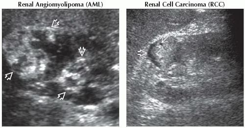 DA15-DB2-Hyperechoic_Renal_Mass-FFU3.gif | Abdominal Key