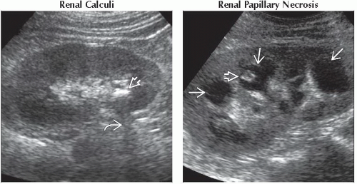 DA15-DB2-Hyperechoic_Renal_Mass-FFU8.gif | Abdominal Key