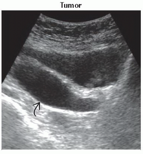 Da16-db1-cystic Dilation Of Distal Ureter-ffu1.gif 