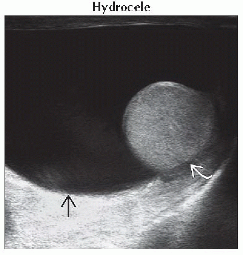 DA19-DB1-Extratesticular_Cystic_Mass-FFU1.gif | Abdominal Key