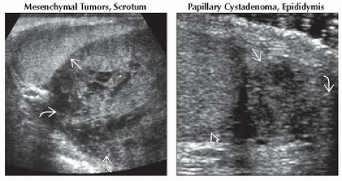 DA19-DB1-Extratesticular_Solid_Mass-FFU5.gif | Abdominal Key