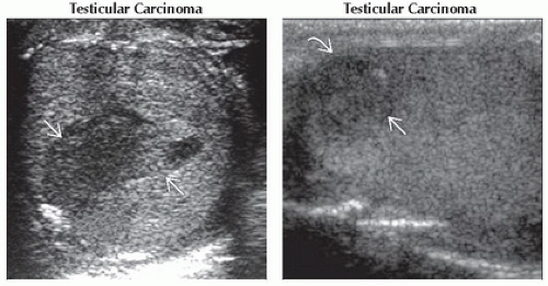 DA19-DB1-Intratesticular_Mass-FFU4.gif | Abdominal Key