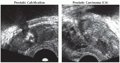 DA20-DB1-Focal_Lesion_in_Prostate-FFU3.gif | Abdominal Key