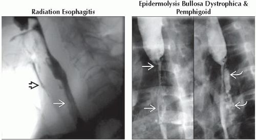 DA3-DB1-Esophageal_Ulceration-FFU5.gif | Abdominal Key