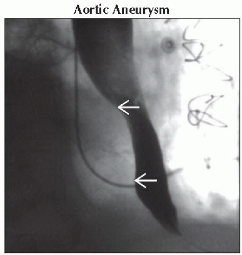 DA3-DB1-Extrinsic_Mass_Esophagus-FFU2.gif | Abdominal Key